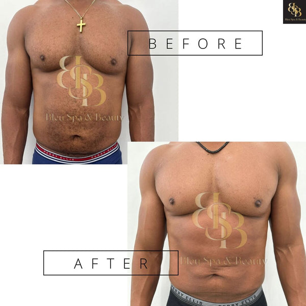 Venus Bliss Max – 6 Sessions Service vividderma 